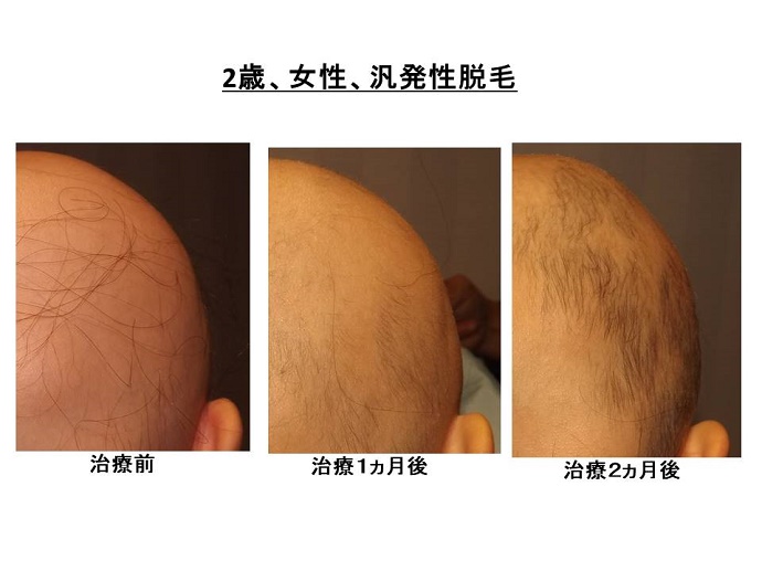円形脱毛症　病院""